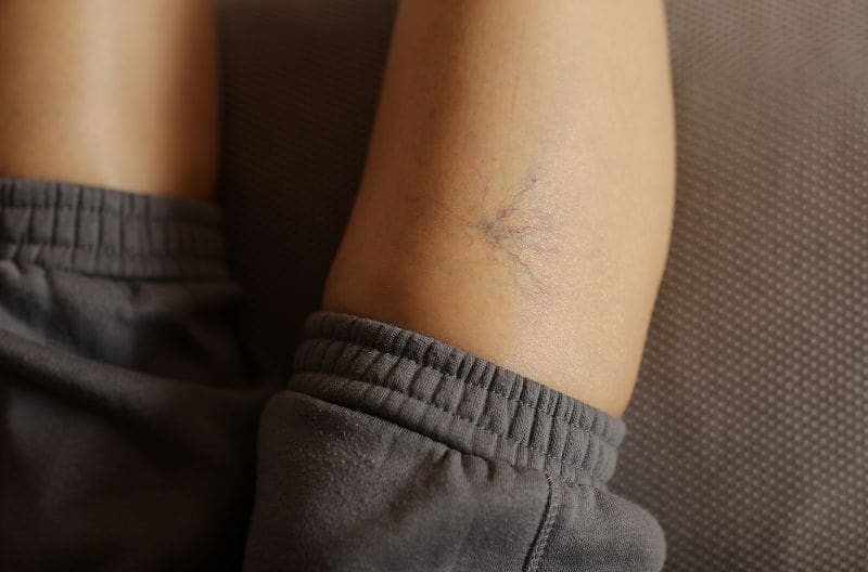 Varices: también un problema de los hombres