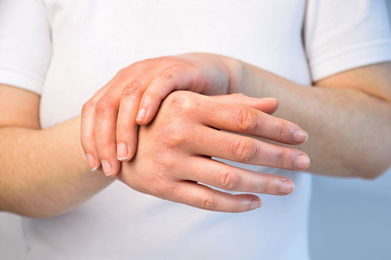 artritis psoriásica