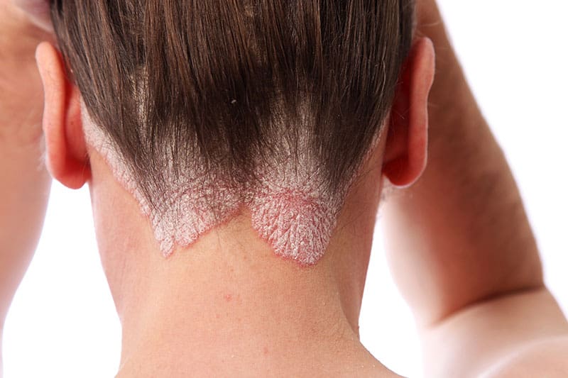 psoriasis nuca
