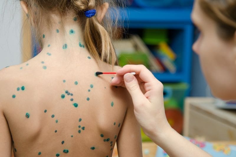 Todo lo que necesitas saber sobre la varicela: Síntomas, tratamiento y prevención